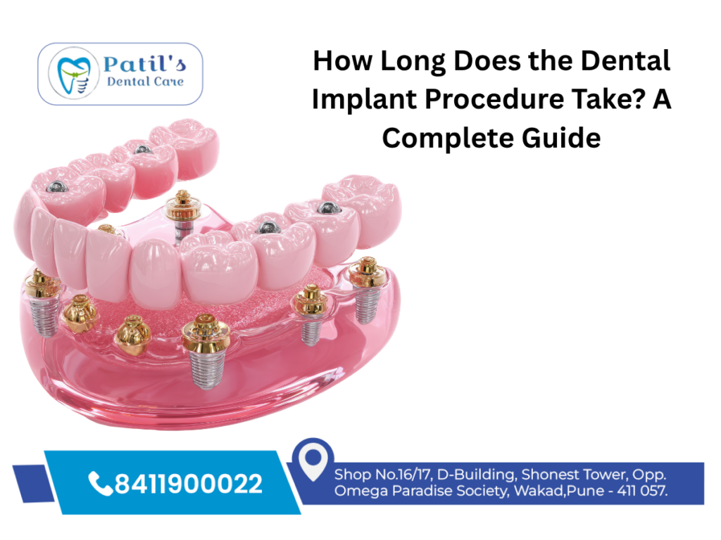 How Long Does the Dental Implant Procedure Take? A Complete Guide