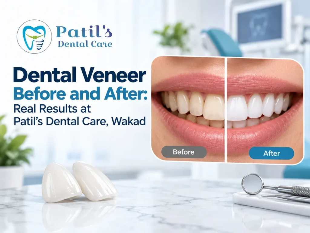 dental veneer before after results Wakad